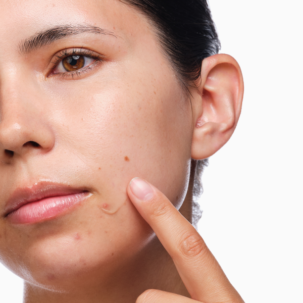 The Acne Set: Salicylic Acid 2% Regimen for Clear Skin - Image 4